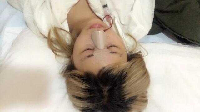 成都蜀尚蓉雅美容整形醫(yī)院做鼻綜合手術(shù)剛剛結(jié)束后