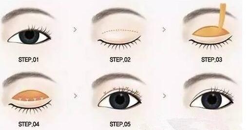 哈爾濱第一醫(yī)院切開(kāi)雙眼皮多少錢(qián)？切開(kāi)雙眼皮如何恢復(fù)？