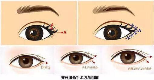 桂林嘉美醫(yī)療開外眼角是什么？開外眼角適用人群？