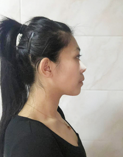 深圳恩吉娜醫(yī)療美容門診部做鼻綜合剛剛做完手術(shù)后 深圳恩吉娜醫(yī)療美容門診部做鼻綜合剛剛做完手術(shù)后