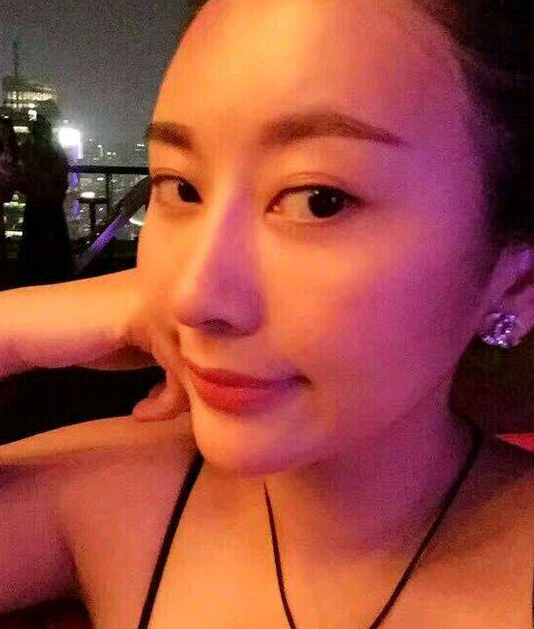 南京美貝爾醫(yī)療美容醫(yī)院黃名斗假體隆鼻案例效果分享