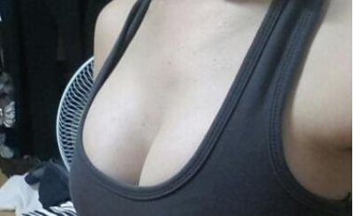 成都美立方（原華博）醫(yī)療美容醫(yī)院黃華假體隆胸案例效果分享