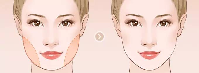 做下頜角整形手術(shù)效果好嗎？下頜角整形手術(shù)要多少錢？