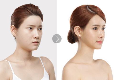 自體脂肪填充眉弓安全嗎？自體脂肪填充是永久的嗎？