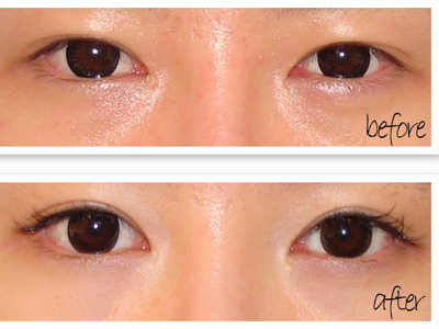 桂林柏琳整形開(kāi)內(nèi)眼角多少錢(qián)？開(kāi)內(nèi)眼角注意哪些?