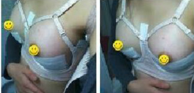 長沙愛思特醫(yī)療美容醫(yī)院做假體隆胸術后的第4天