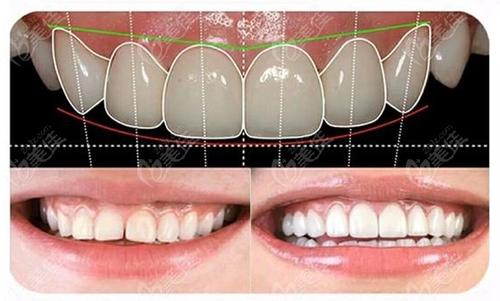 池州博雅口腔全瓷牙有何優(yōu)點？全瓷牙與烤瓷牙有何區(qū)別？