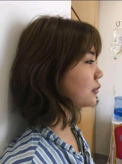 上海美萊醫(yī)療美容門診部盧建隆鼻案例效果分享