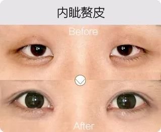 哈爾濱成美整形內眥贅皮矯正怎么樣有哪幾種手術方法？
