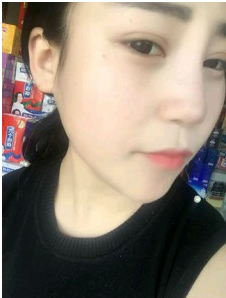 上海時光整形外科醫(yī)院做耳軟骨隆鼻術后自然的鼻子 上海時光整形外科醫(yī)院做耳軟骨隆鼻術后自然的鼻子