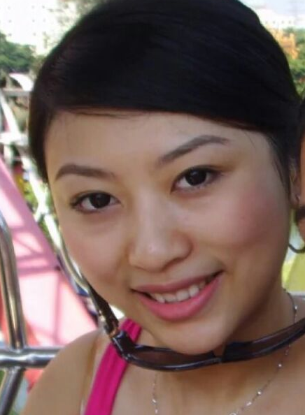 南京美貝爾醫(yī)療美容醫(yī)院黃名斗假體隆鼻案例效果分享