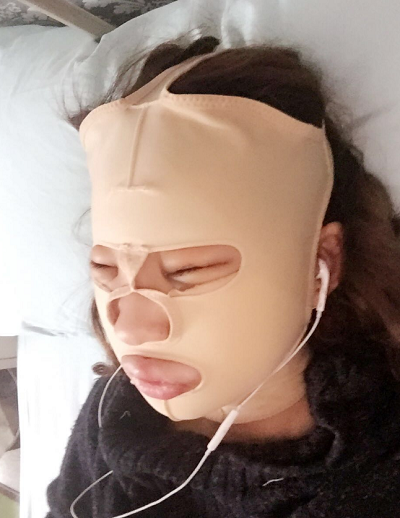 北京京民醫(yī)院（原釣魚臺醫(yī)院）整形外科做下頜骨手術后的恢復情況