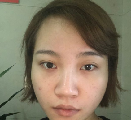 上海時(shí)光整形外科醫(yī)院做鼻綜合手術(shù)前