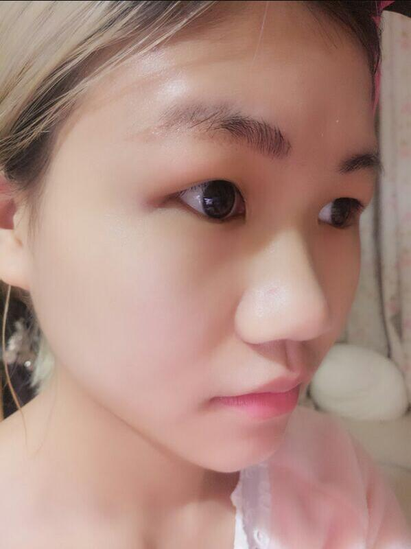 成都蜀尚蓉雅美容整形醫(yī)院陳秀榮鼻綜合案例效果分享